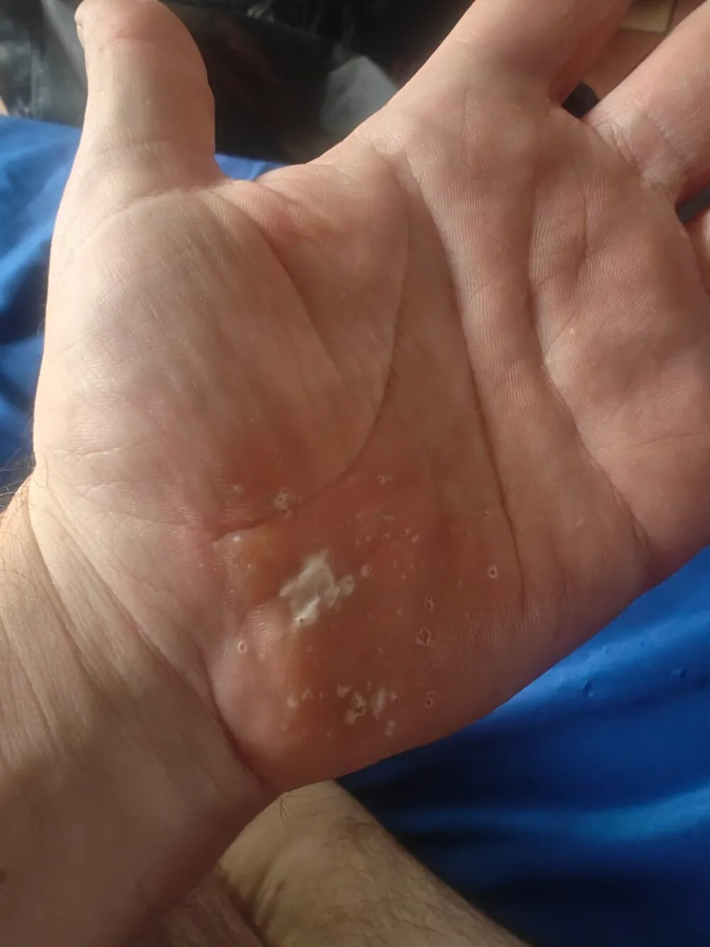 Palms are stating to develop callous