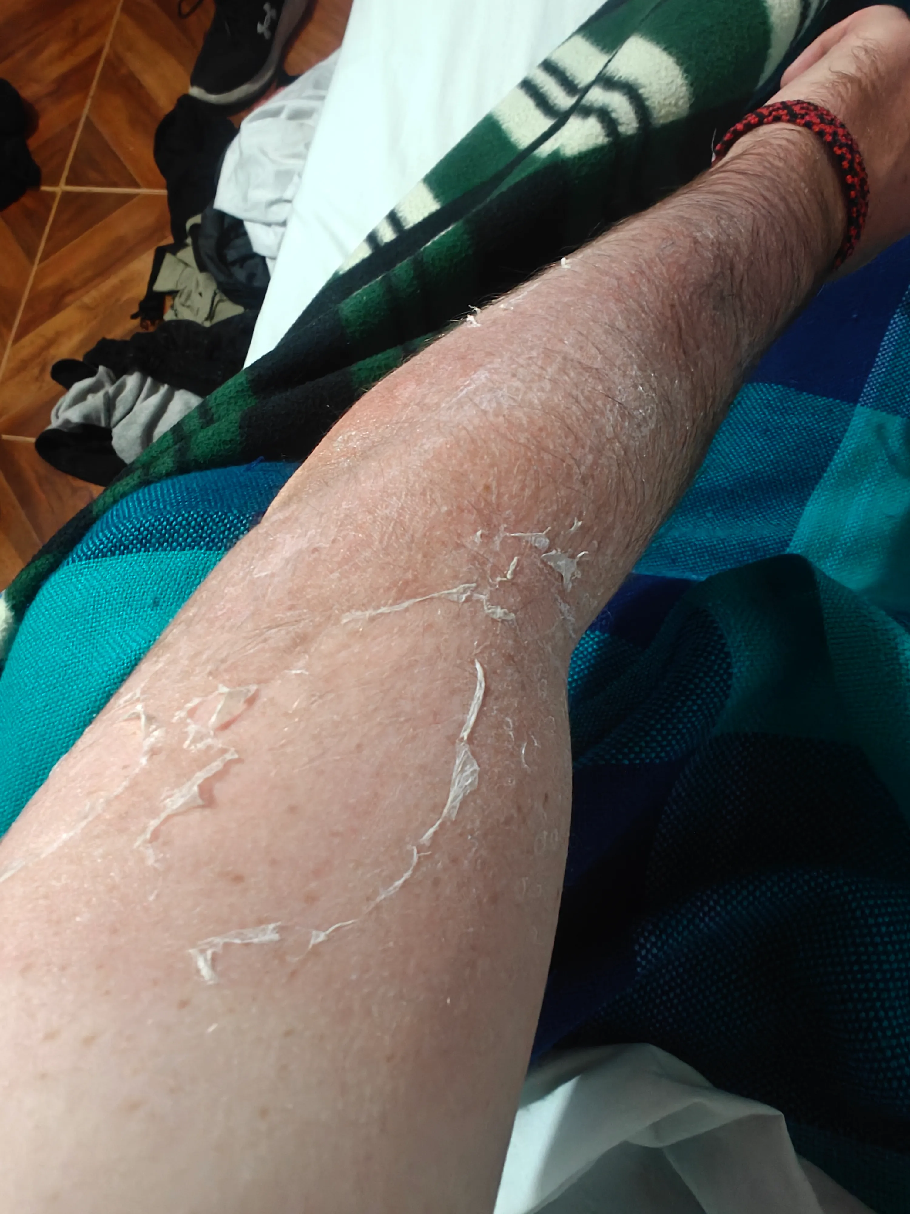 Got pretty badly sunburned